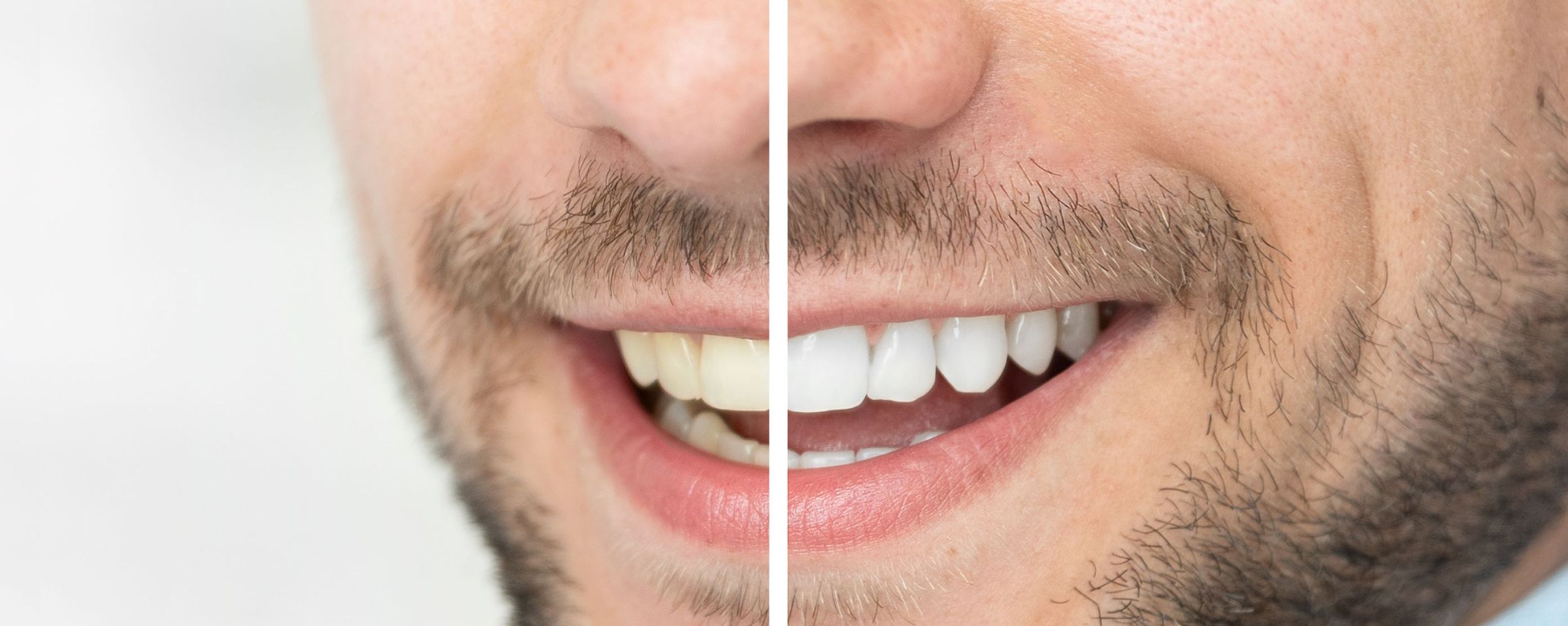 Teeth Whitening