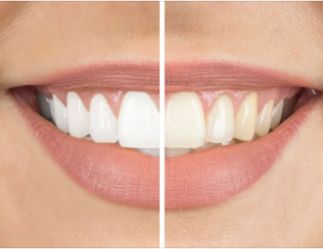 Whitening