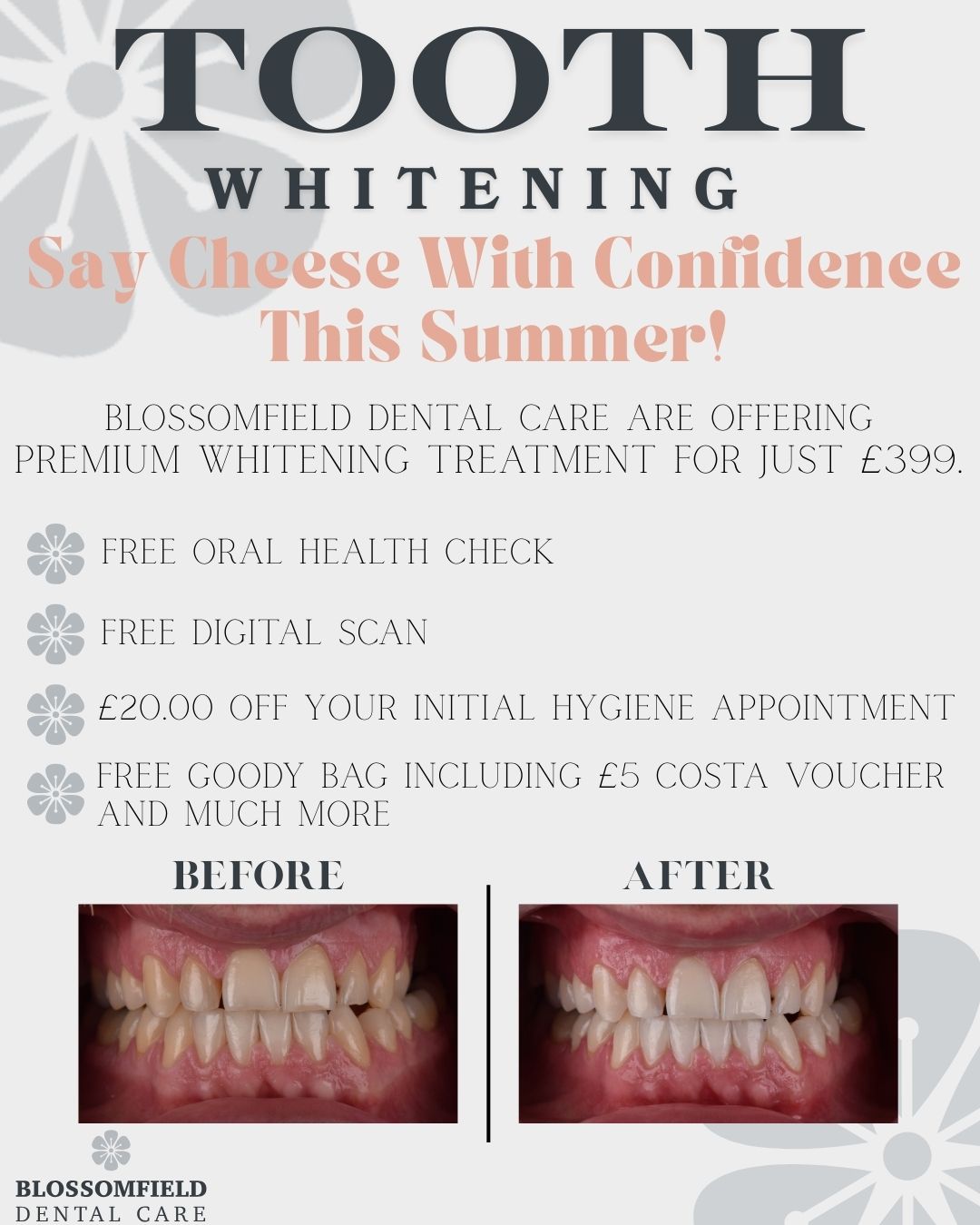 Brighten Your Smile This Season with Our Exclusive Teeth Whitening Offer