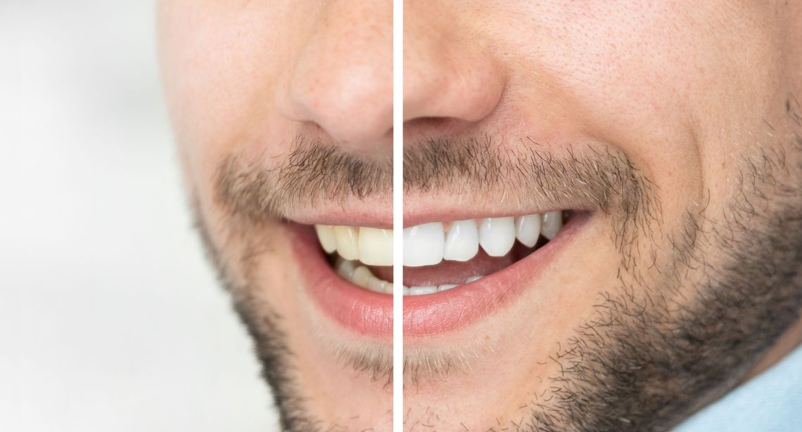 Teeth Whitening